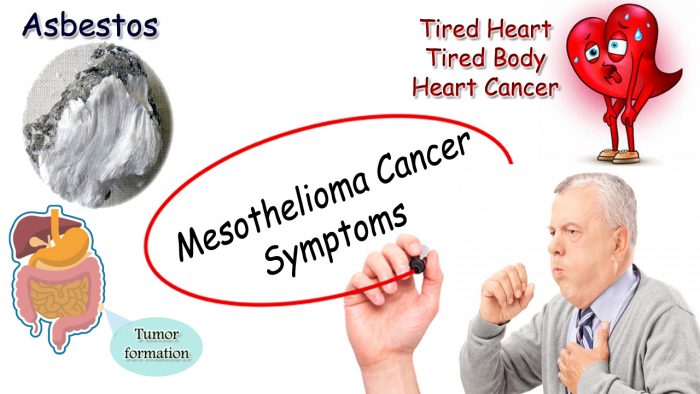 Mesothelioma Cancer Symptoms